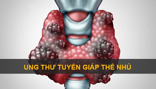 Ung thư tuyến giáp thể nhú kiêng ăn gì? Dinh dưỡng dành cho bệnh nhân. Tổng quan về căn bệnh ác tính - Ung thư tuyến giáp thể nhú là gì?