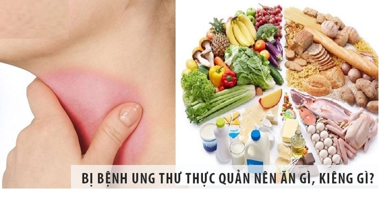 Giải đáp thắc mắc khác: Ung thư thực quản nên ăn gì?