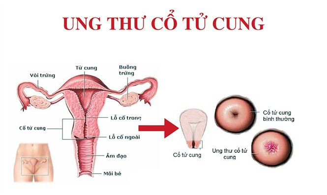 Ung thư cổ tử cung là gì?